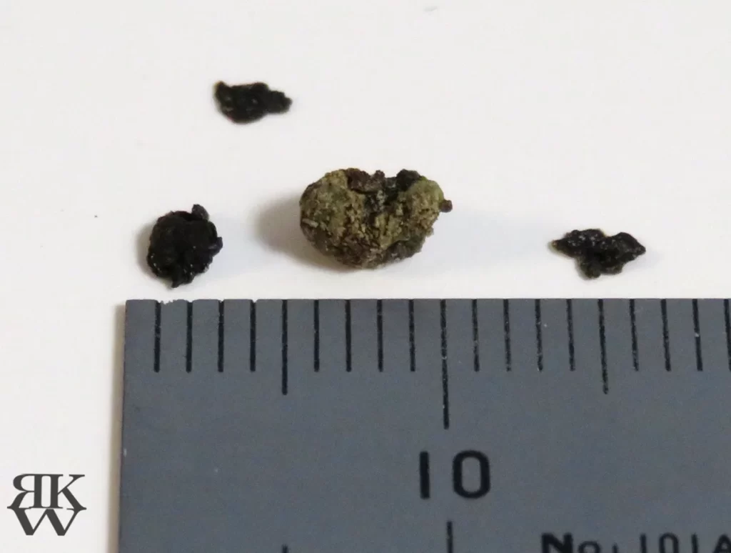 手術で取った胆石